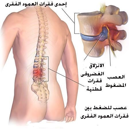 حقن جذور الأعصاب: الدقة في التشخيص والراحة في العلاج